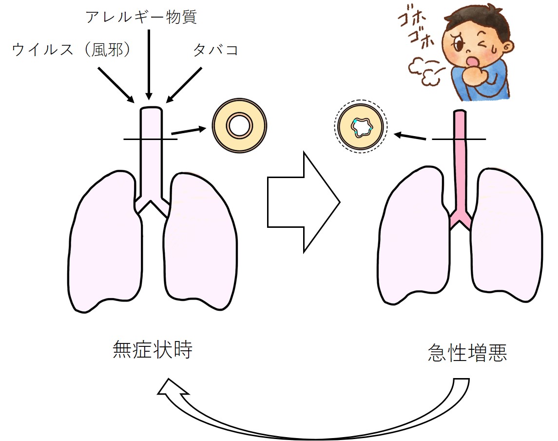 気管支喘息に対する呼吸器診療 目黒ケイホームクリニック 目黒区の訪問診療 内科 呼吸器内科 循環器内科 アレルギー科